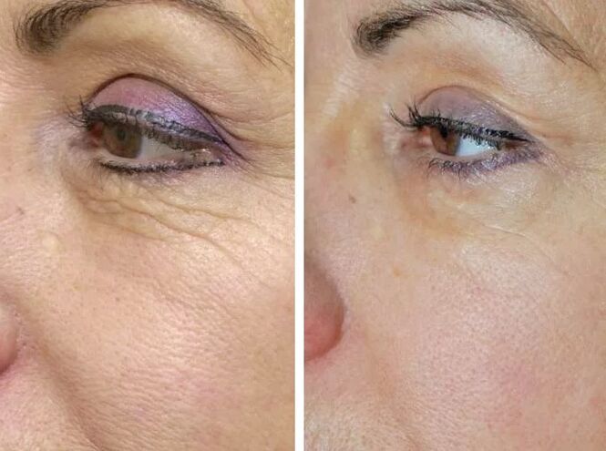 Önceki ve sonrası alan lazeri